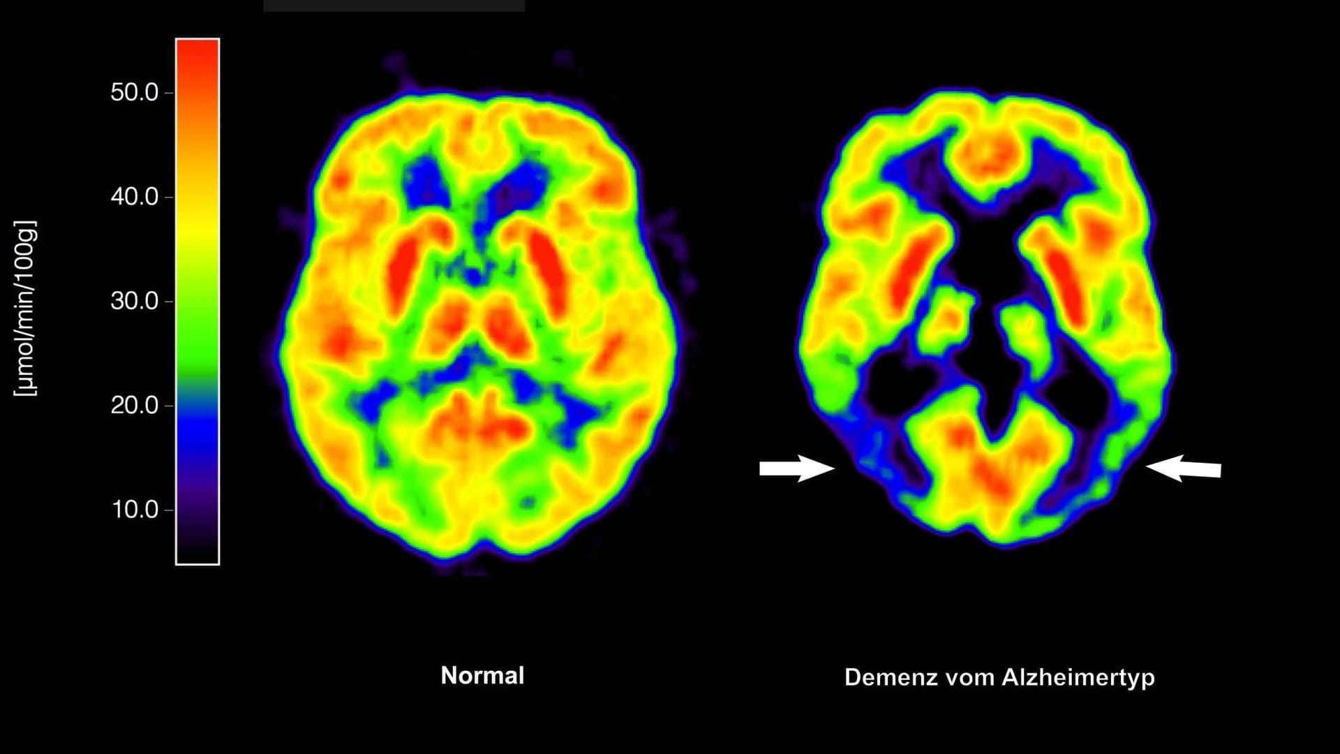 Alzheimer-Erkrankung