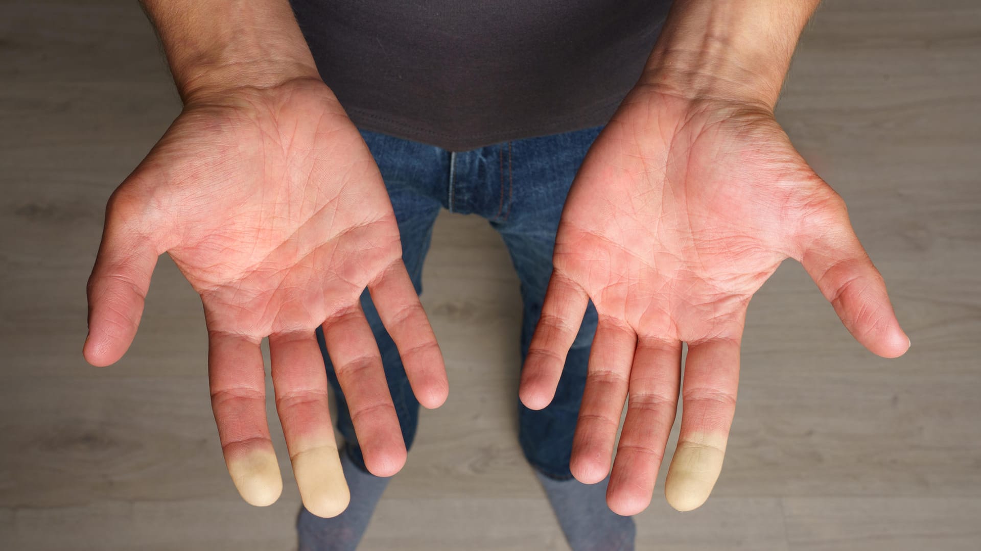 Sekundäres Raynaud-Syndrom an den Händen.