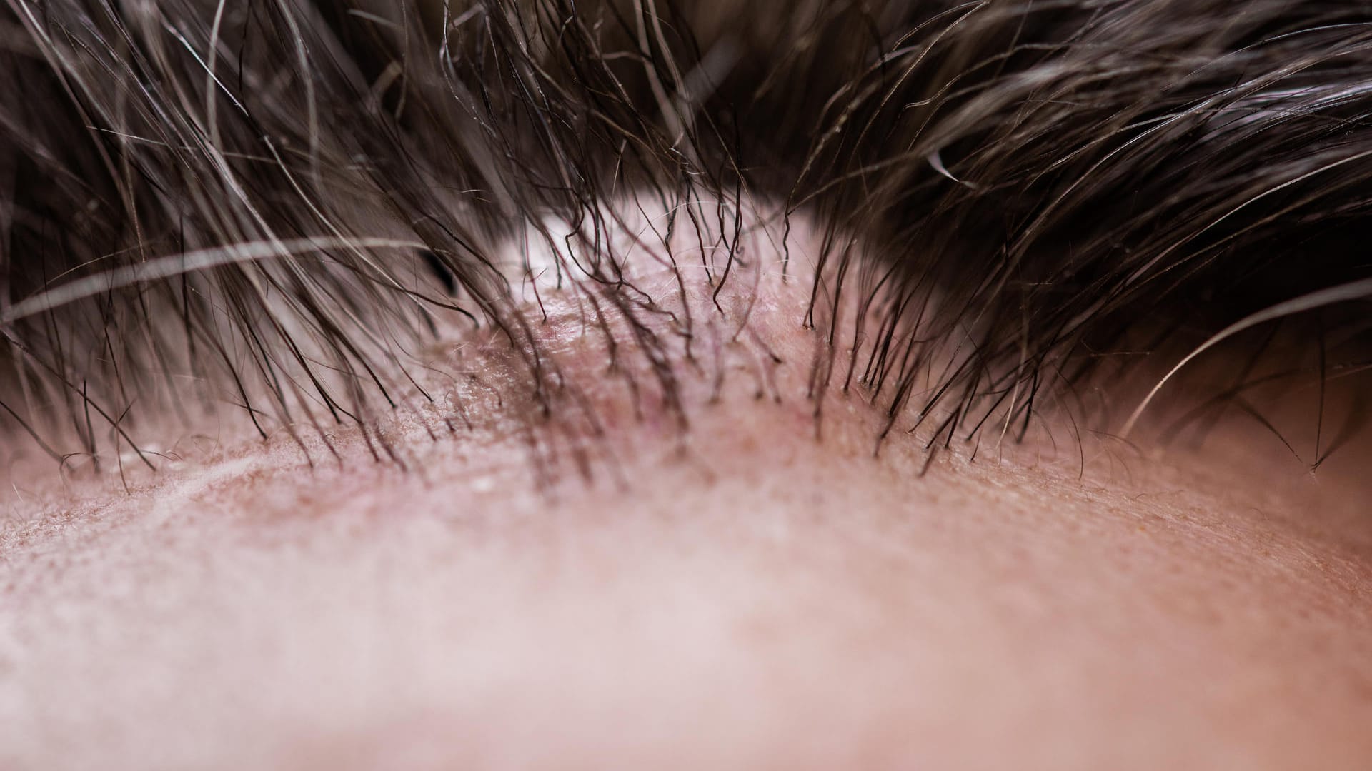 Grützbeutel auf dem Kopf: Ist das Atherom sehr groß, können die Haare darauf verdrängt werden.