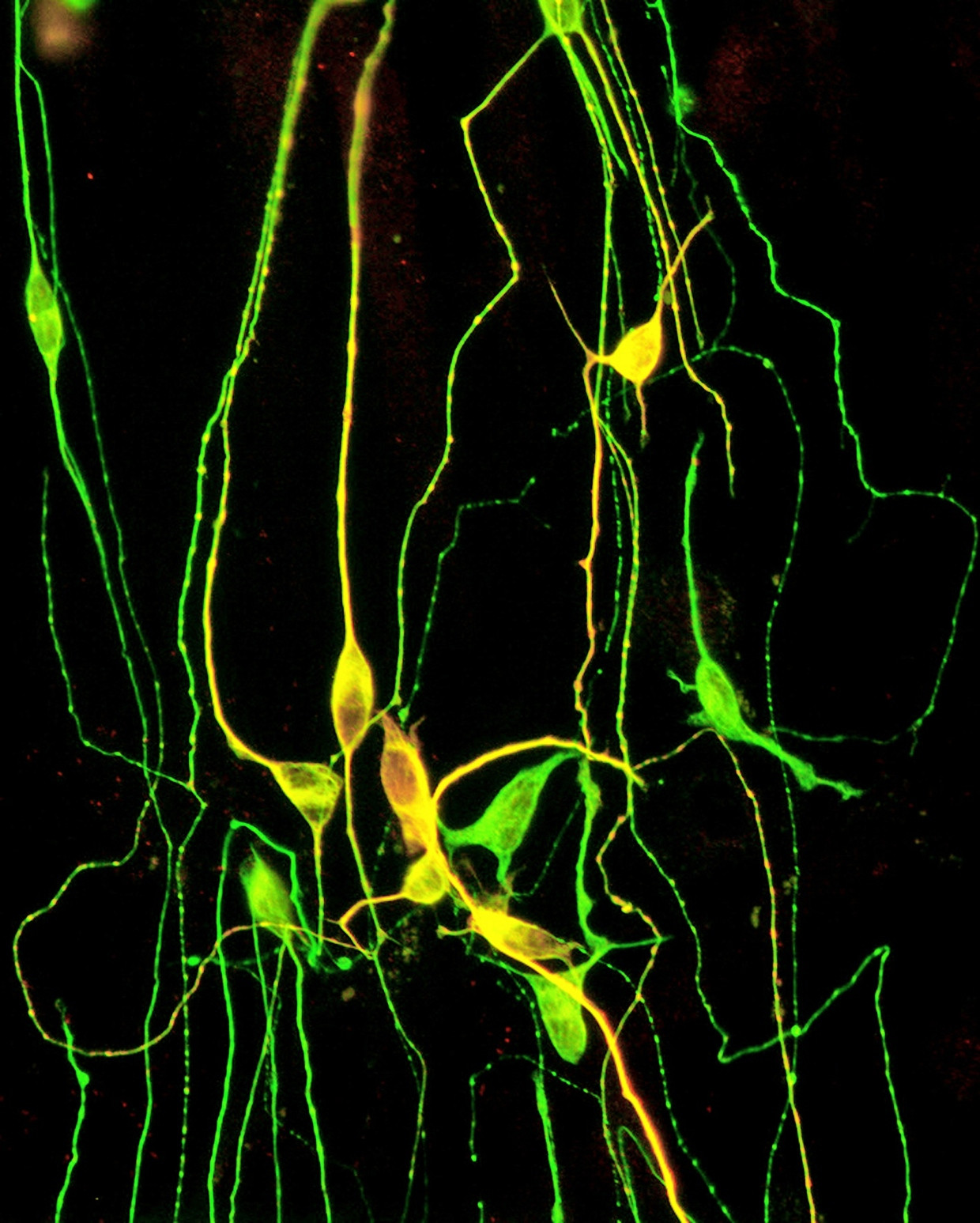 Im Labor aus Hautzellen hergestellte Neurone, die in einem Vorstadium in die Gehirne von Parkinson-Patienten eingepflanzt werden.