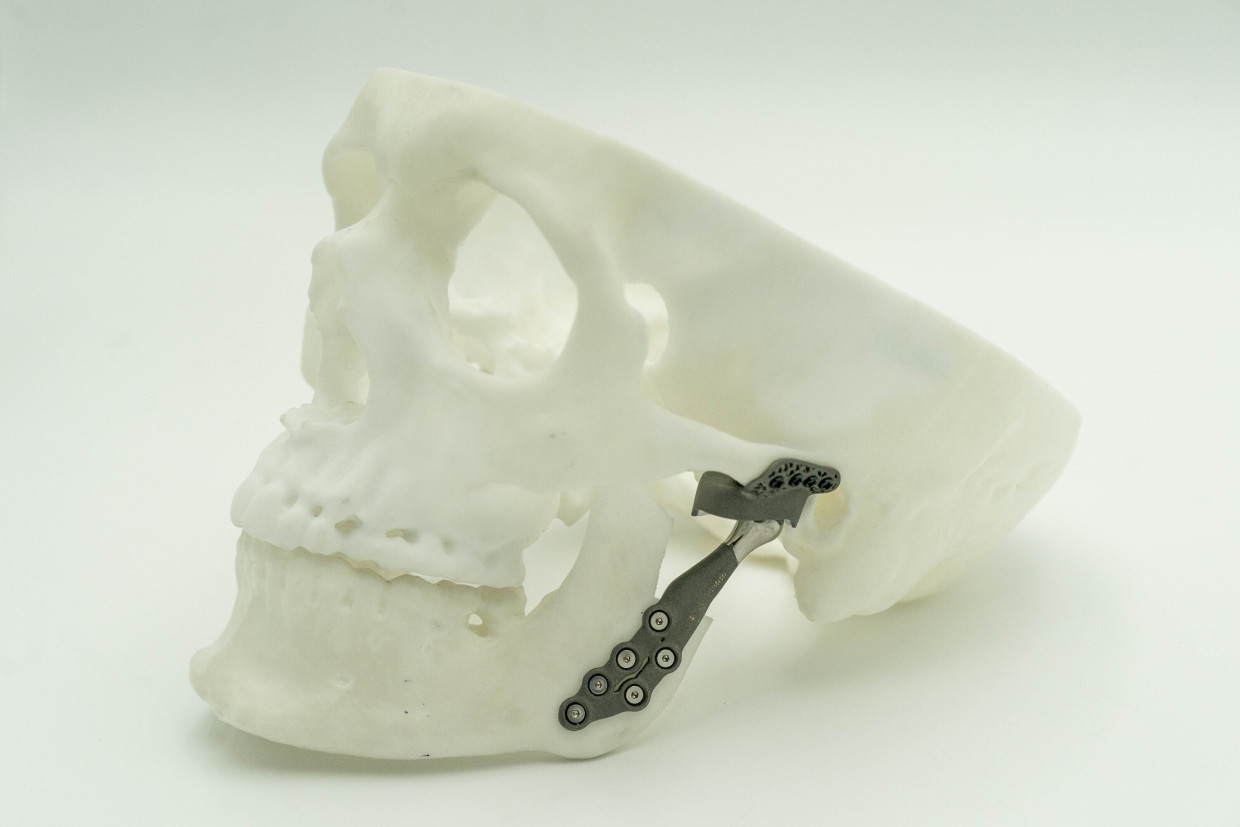 Kieferimplantat aus Titan