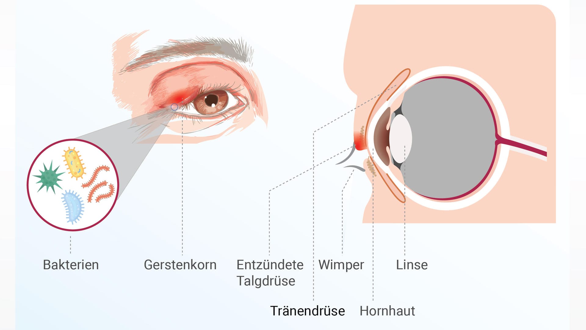 Grafische Darstellung eines Gerstenkorns: Bakterien siedeln sich in einer verstopften Drüse an. Grafische Darstellung eines Gerstenkorns: Bakterien siedeln sich in einer verstopften Drüse an.