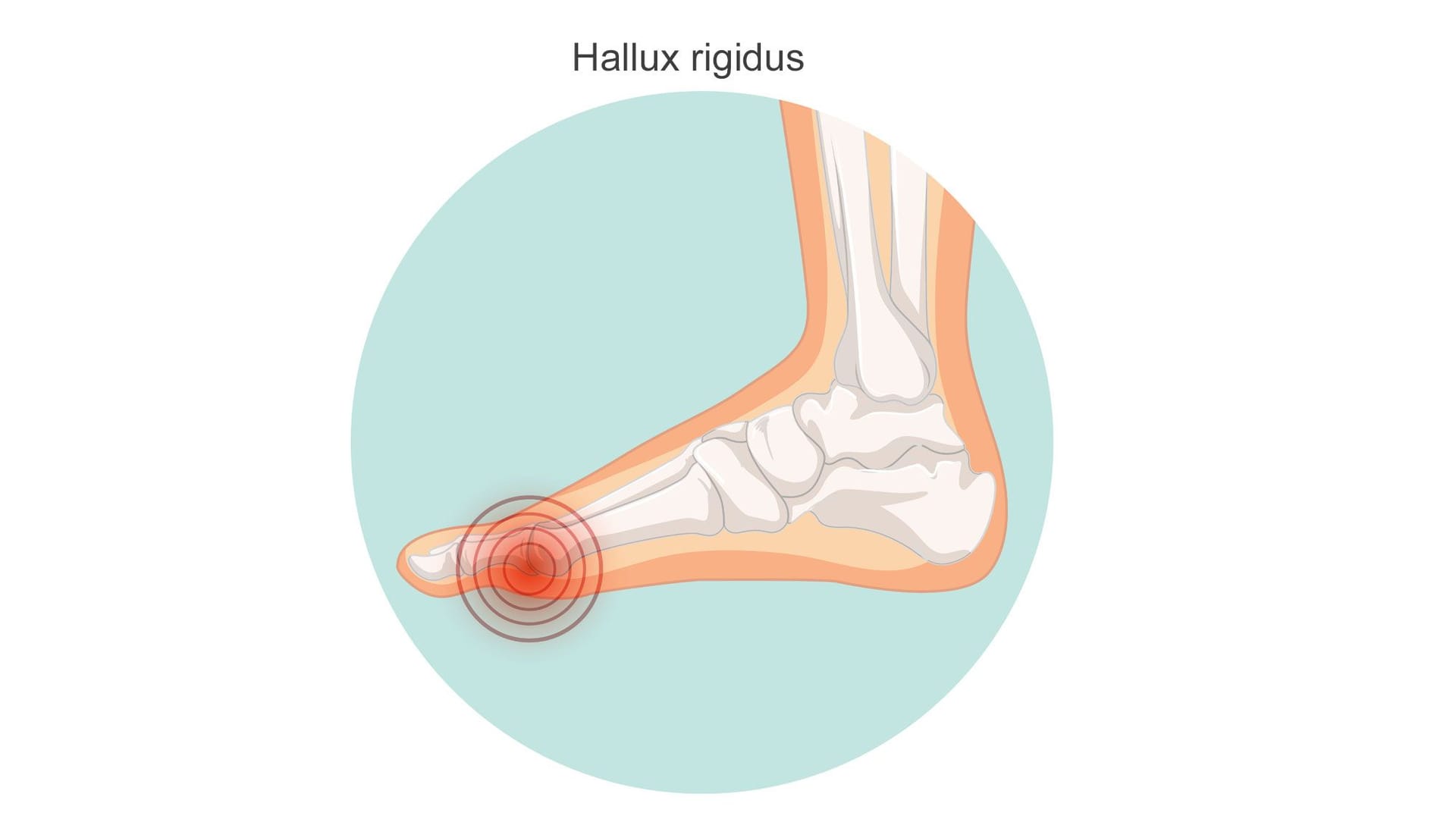 Illustration eines Hallux rigidus: Das Großzehengrundgelenk verbindet den Mittelfußknochen und den ersten Zehenknochen. Illustration eines Hallux rigidus: Das Großzehengrundgelenk verbindet den Mittelfußknochen und den ersten Zehenknochen.