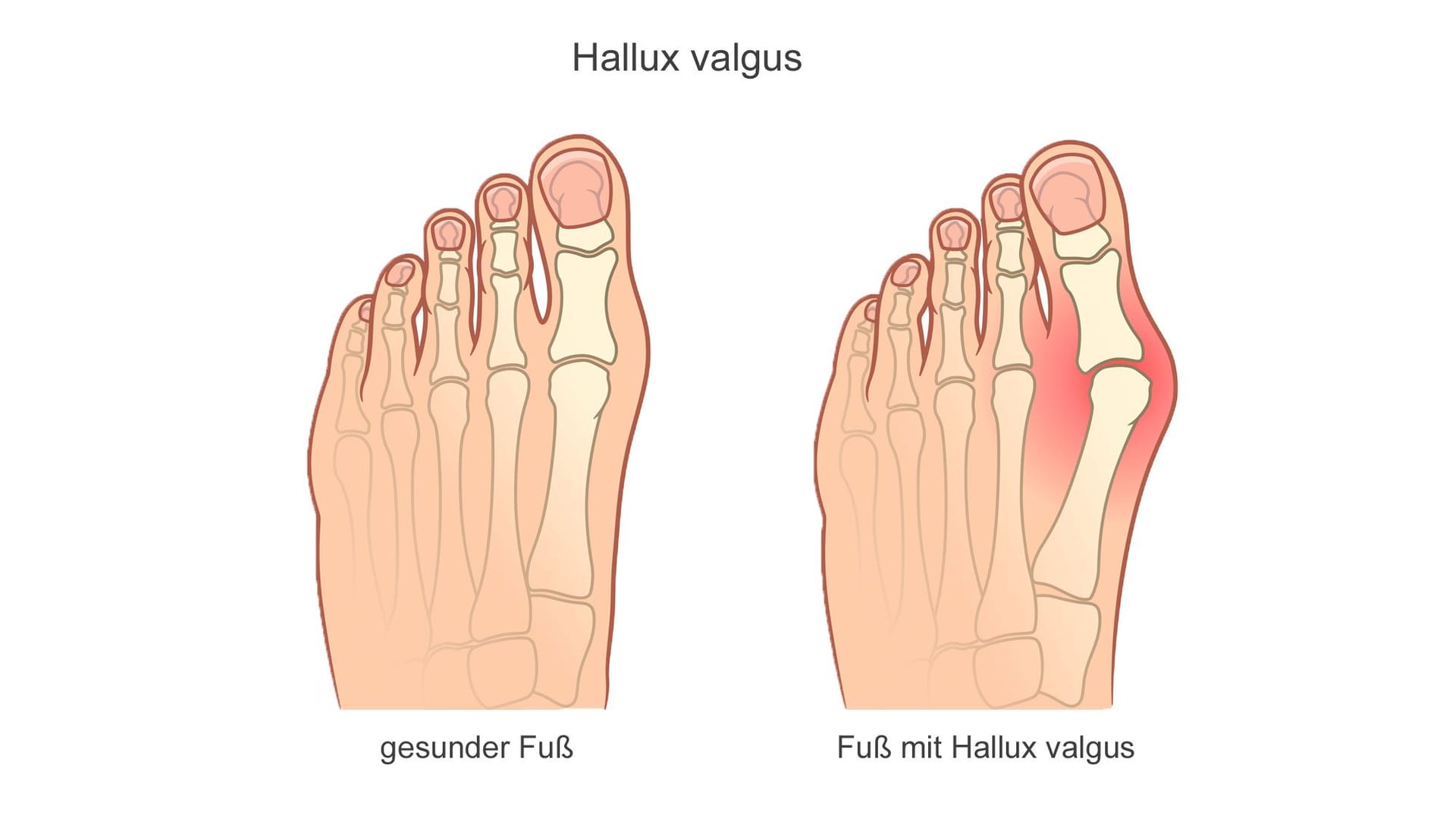 Hallux valgus ist auch als Ballenzeh bekannt. Hallux valgus ist auch als Ballenzeh bekannt.