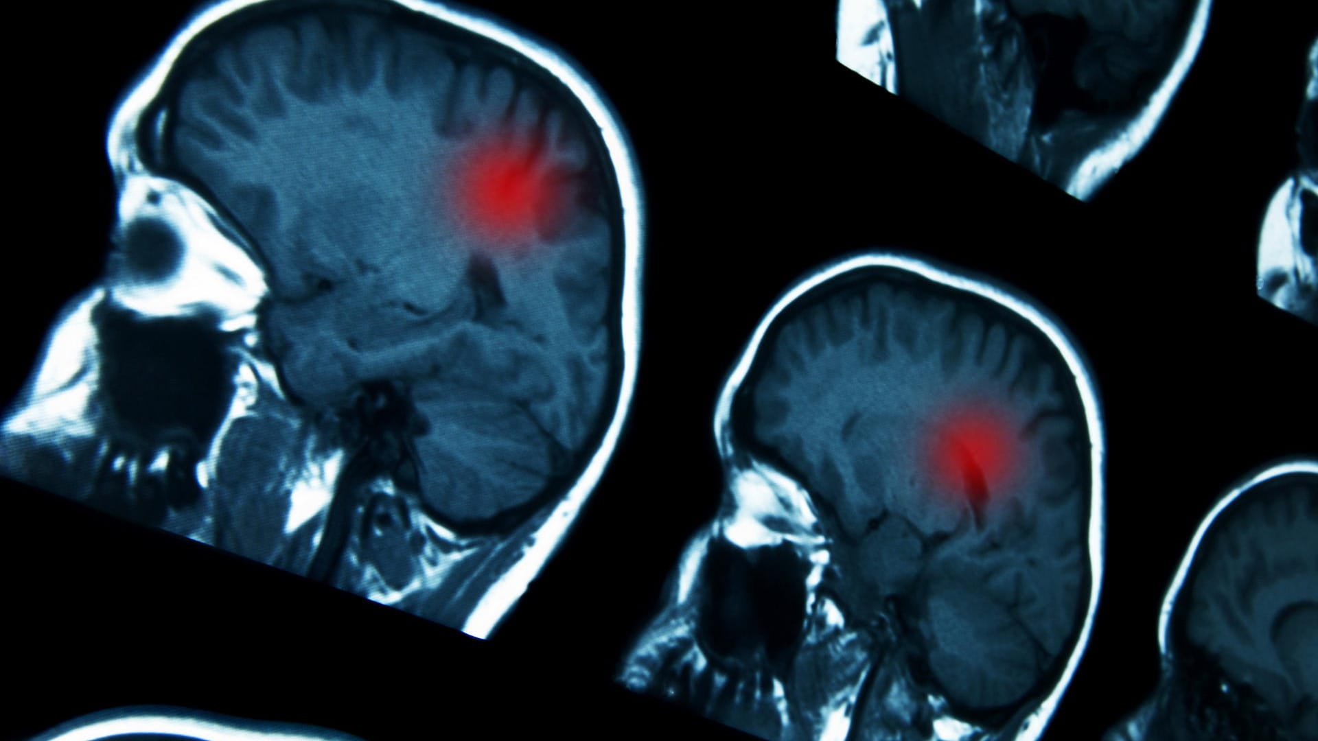 Darstellung des Gehirns in einer Magnetresonanztomografie (MRT); Das bildgebende Verfahren wird bei der Diagnose von Hirntumoren eingesetzt. Darstellung des Gehirns in einer Magnetresonanztomografie (MRT); Das bildgebende Verfahren wird bei der Diagnose von Hirntumoren eingesetzt.