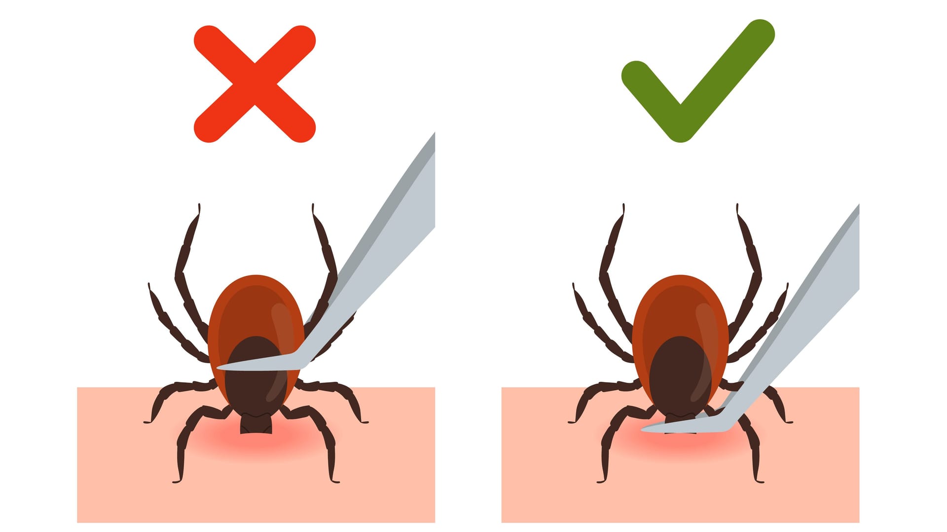 Illustration zur richtigen Handhabung einer Zeckenpinzette Illustration zur richtigen Handhabung einer Zeckenpinzette