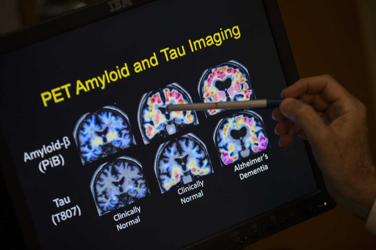 Alzheimer-Frühtests zur Ermittlung des Gehirnzustands gibt es inzwischen viele, auch die Bildgebung spielt eine zentrale Rolle und verbessert sich immer mehr.