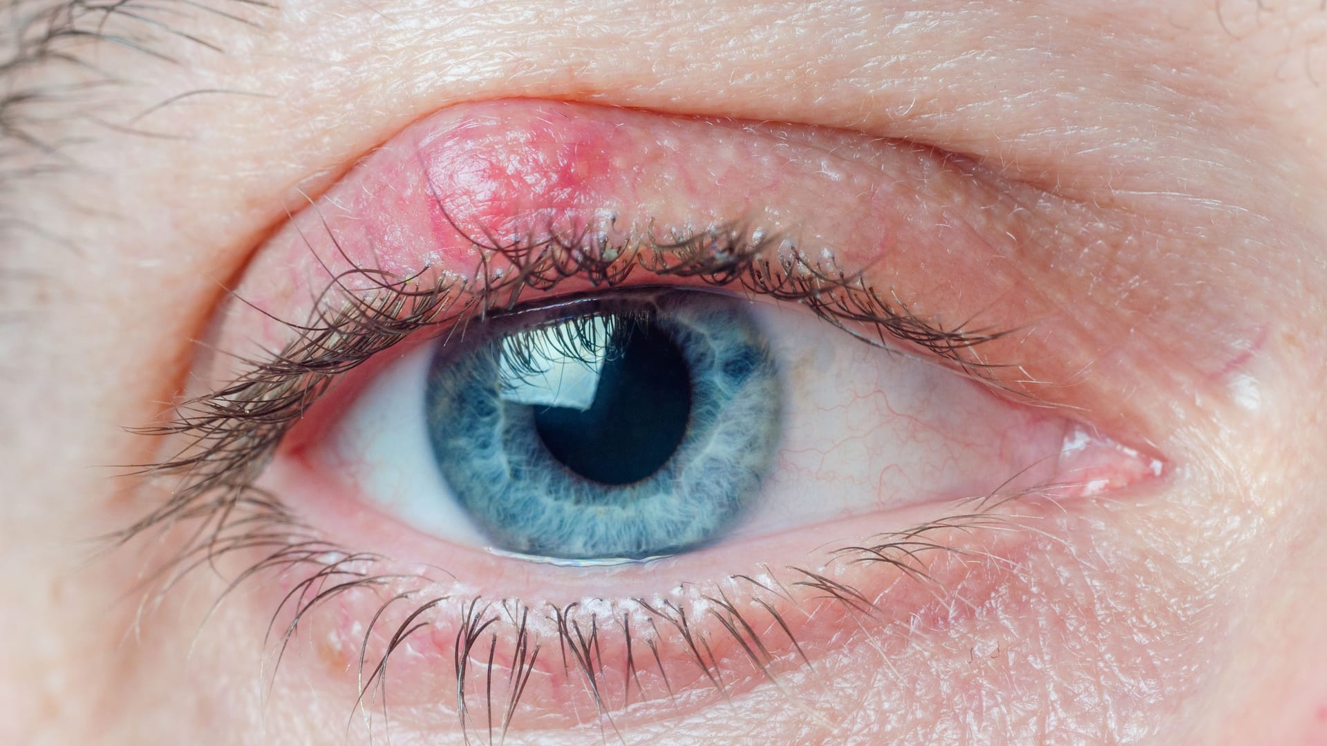 Hagelkorn am Auge: Das Knötchen bereitet in der Regel keine Schmerzen.