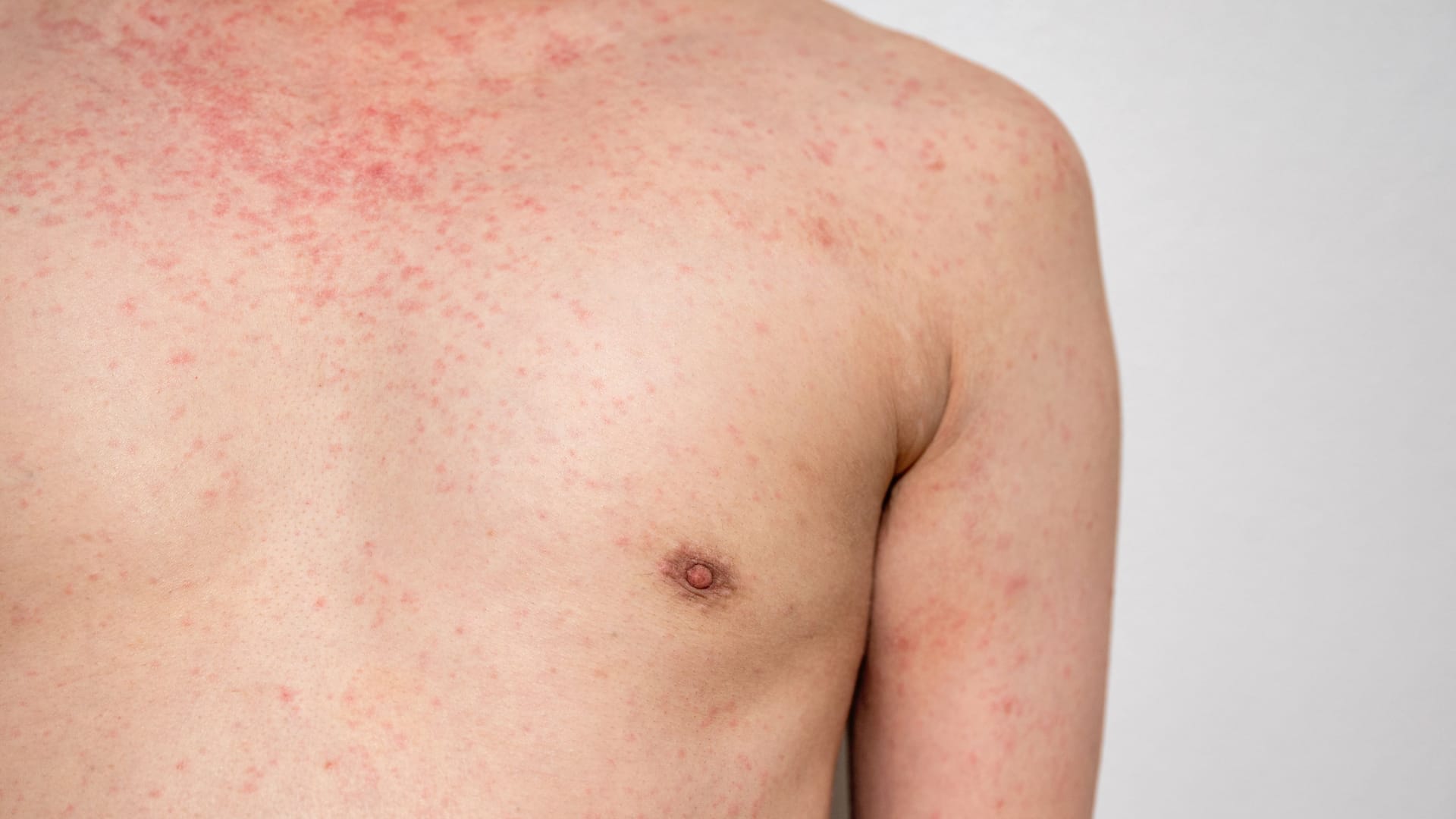 Ausschalg am ganzen Körper: Feine rote Pusteln können bei Hepatitis A auftreten. Ausschalg am ganzen Körper: Feine rote Pusteln können bei Hepatitis A auftreten.