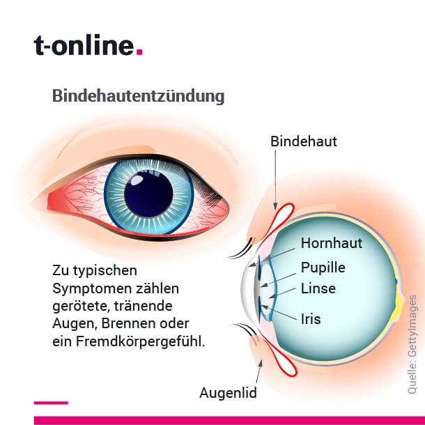 Bindehautentzündung: Typische Symptome sind gerötete, tränende Augen, Brennen oder ein Fremdkörpergefühl.