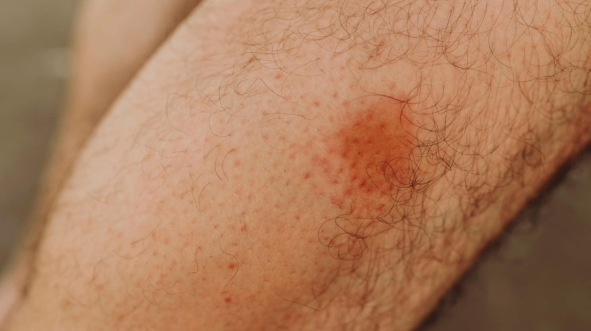 Kriebelmückenbiss: Er kann unangenehme Folgen haben. Kriebelmückenbiss: Er kann unangenehme Folgen haben.