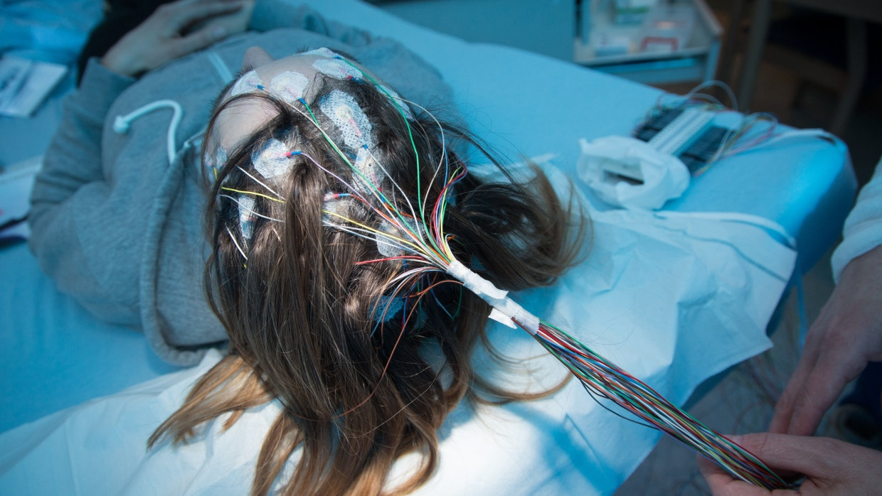 Elektroden zur Messung von Gehirnströmen sind bei einer an Epilepsie erkrankten Patientin auf der Kopfhaut befestigt.