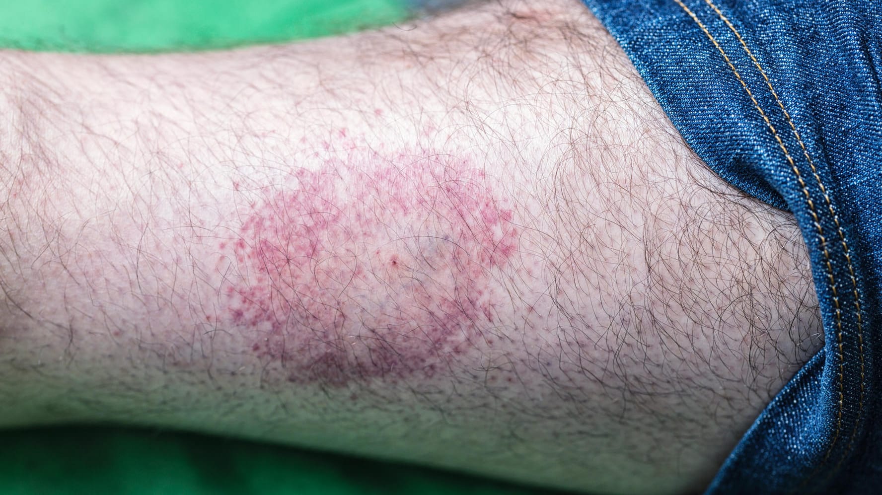 Ringförmige Rötung um den Zeckenstich: Die Wanderröte ist ein typisches Anzeichen für eine Borreliose. Ringförmige Rötung um den Zeckenstich: Die Wanderröte ist ein typisches Anzeichen für eine Borreliose.