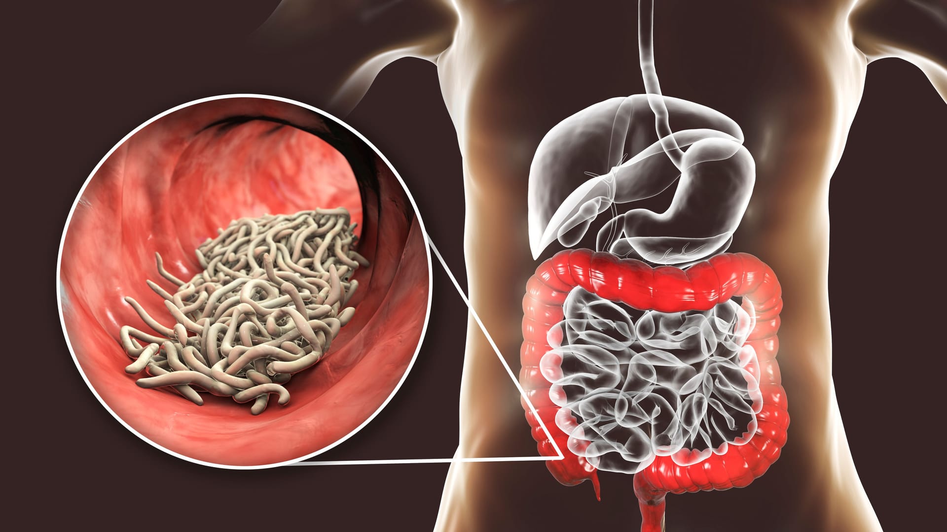 Illustration: Madenwürmer (Enterobius vermicularis) im Darm Illustration: Madenwürmer (Enterobius vermicularis) im Darm